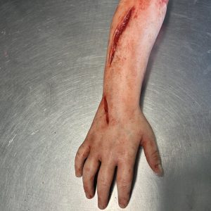 Severed Child Arm